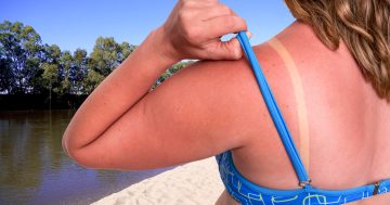 Don't get burned on Wagga Beach! The Riverina city listed as a melanoma hotspot